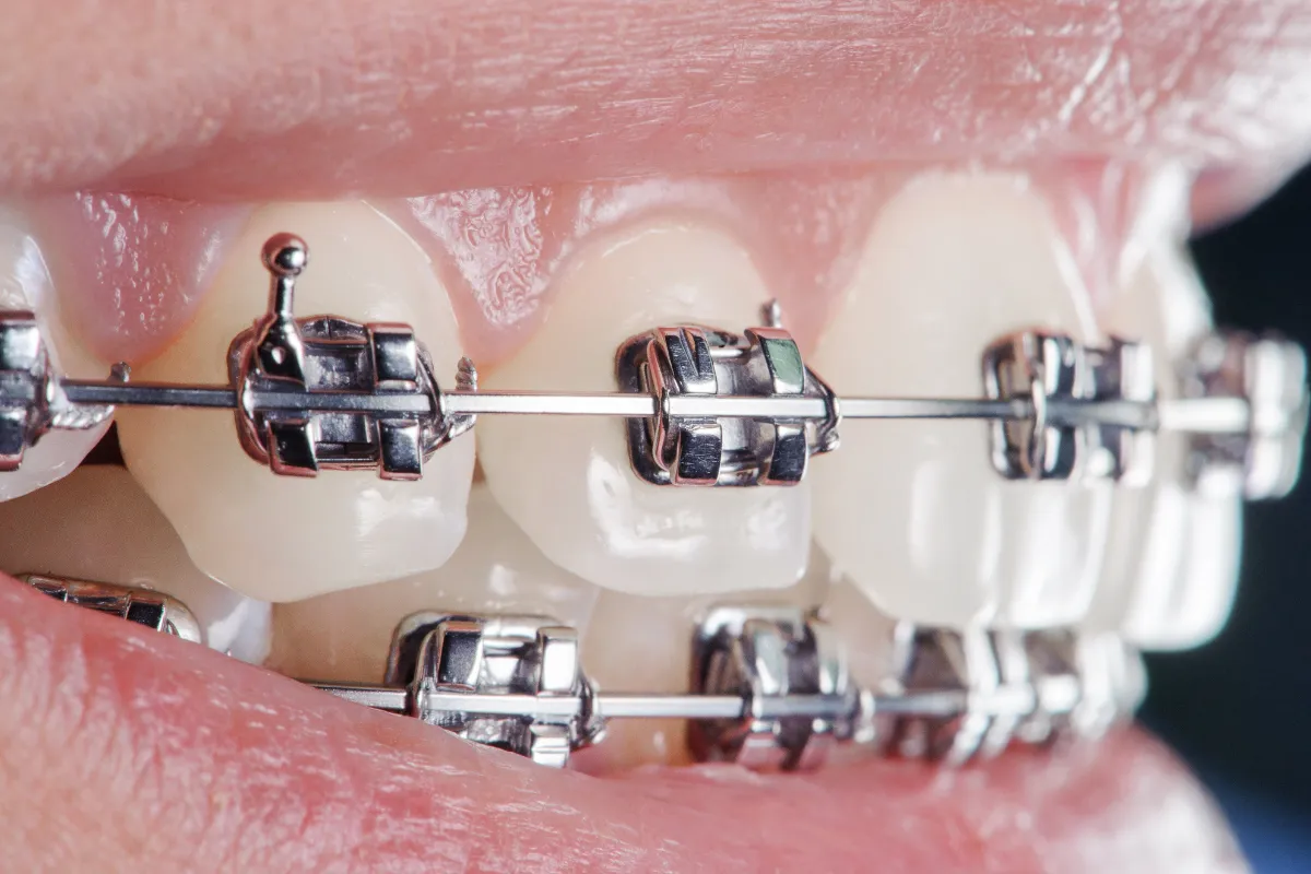 Options for achieving a straighter smile
