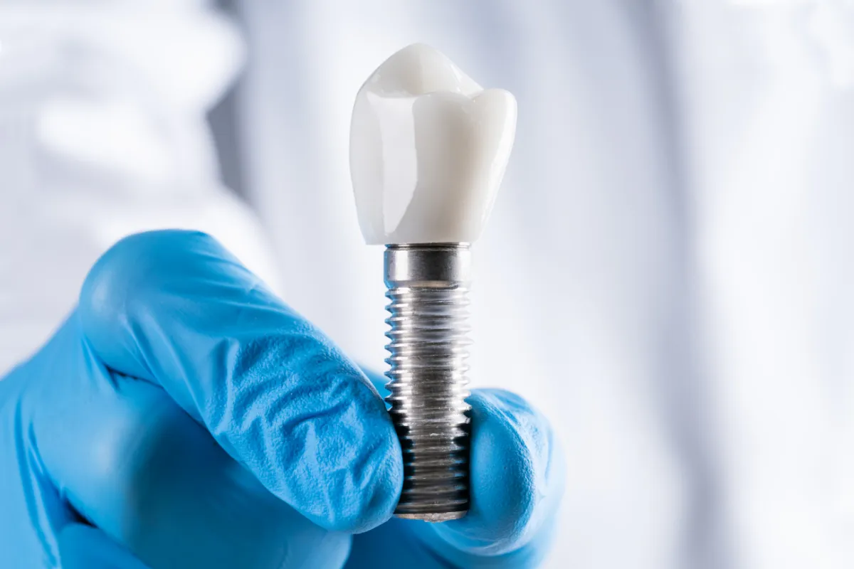 All-on-4 Dental Implants: Are They Right for You in Boynton Beach? 5