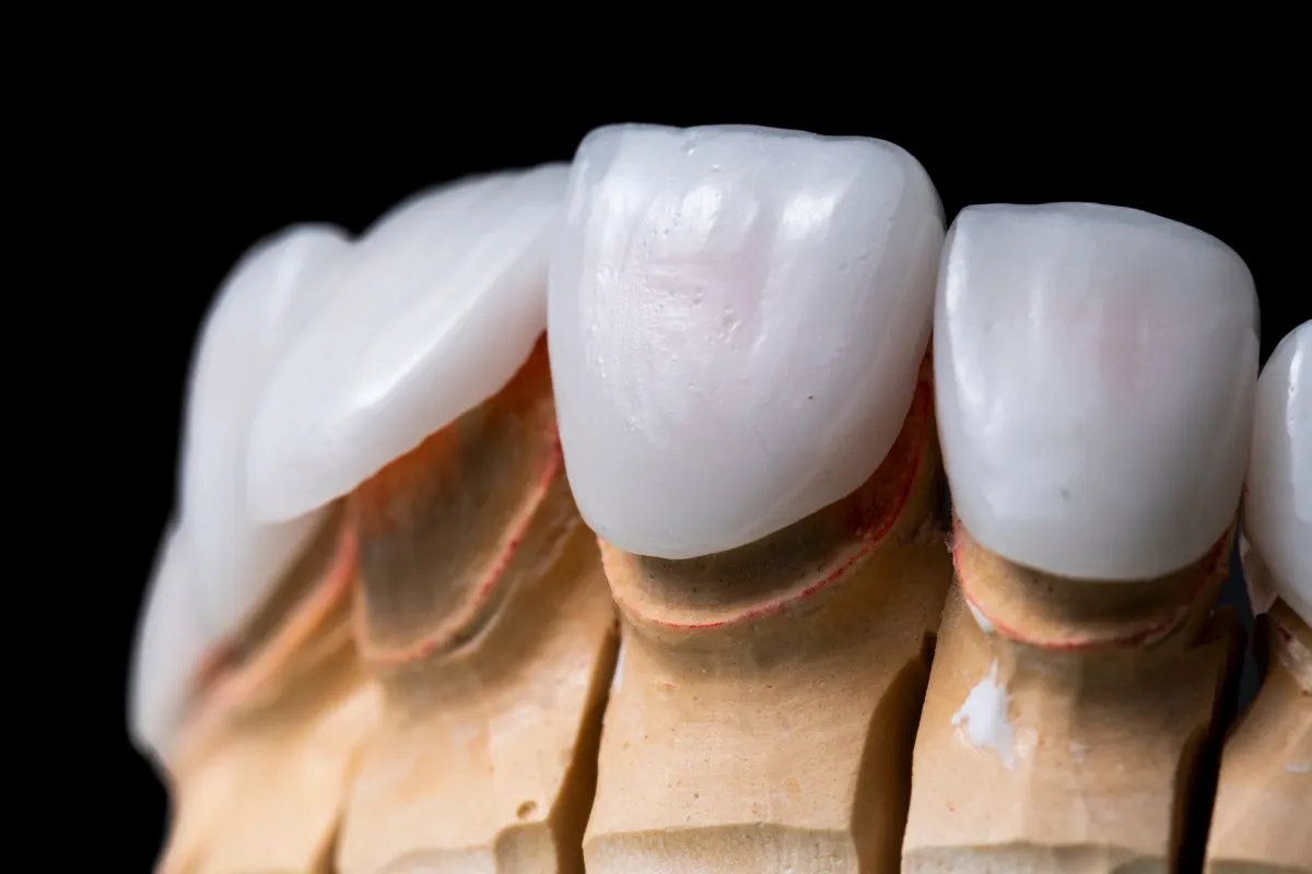 Veneers in Boynton Beach: Achieving Your Dream Smile on Military Trail 1 Close-up of Veneers