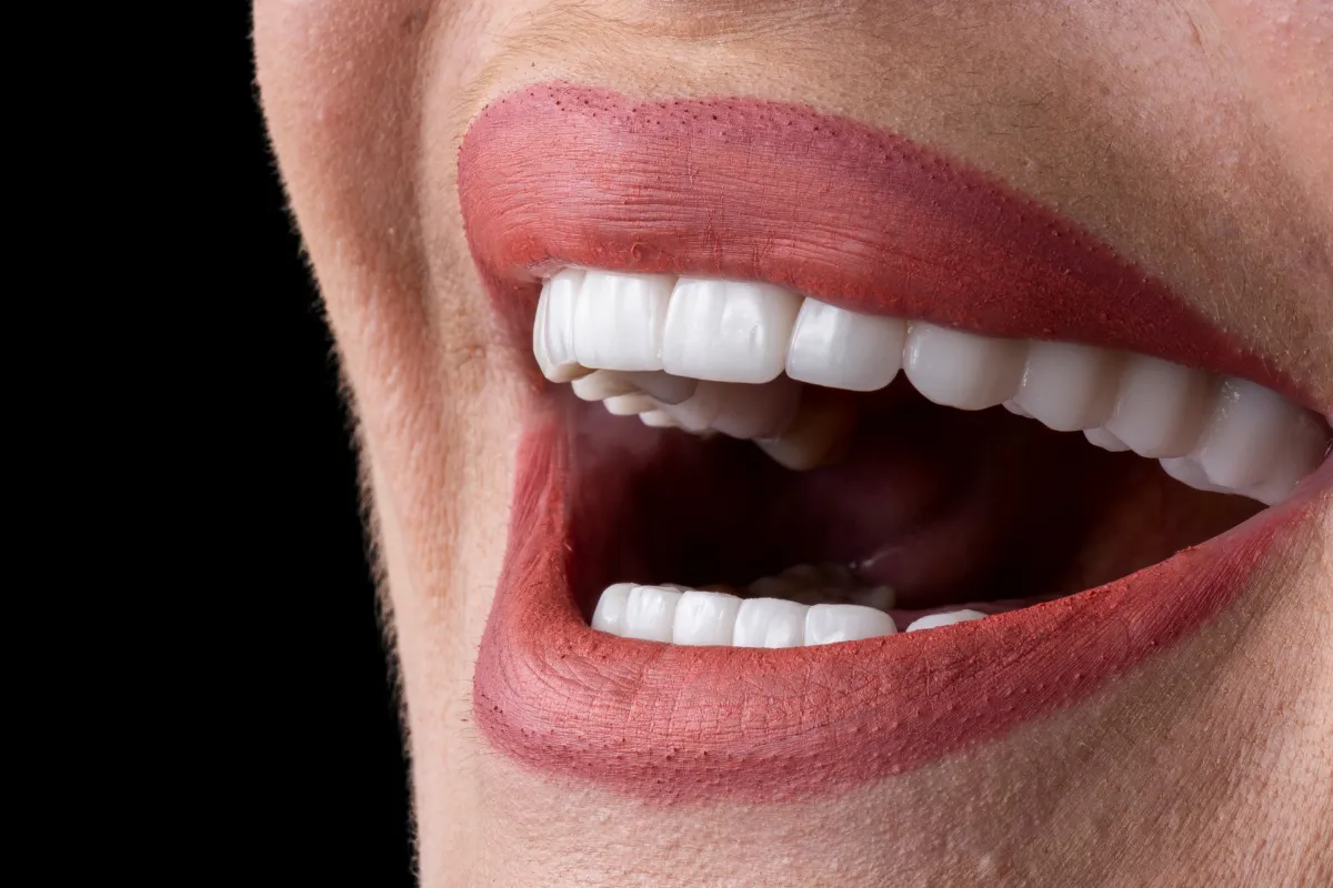 Veneers in Boynton Beach: Achieving Your Dream Smile on Military Trail 2 Veneer Procedure Steps