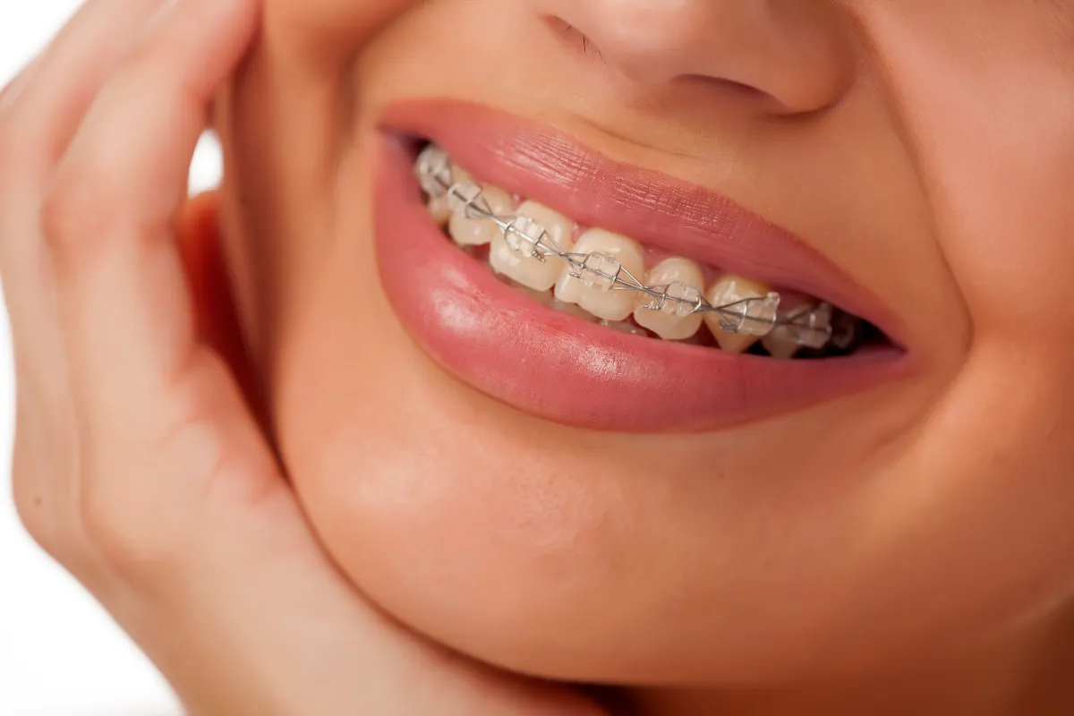 Braces vs. Clear Aligners: Which is Right for You in Boynton Beach? 7