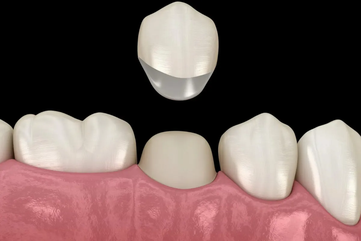Dental Crowns: Restoring Damaged Teeth near Boynton Beach's Military Trail 2 Dentist placing a dental crown on a patient
