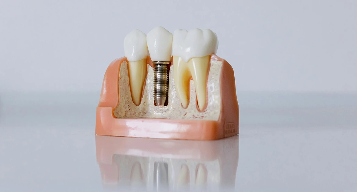 snap-on dentures supported by dental implants structure illustration